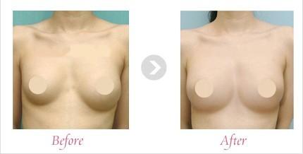 胸部修复手术，隆胸修复的方法，胸修复的方法有哪些