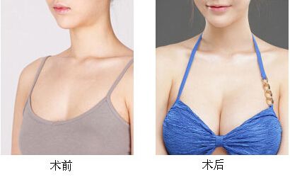 隆胸手术的价格