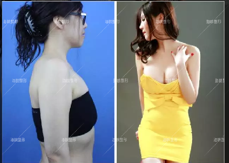 隆胸 