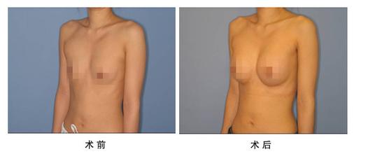 假体隆胸照片前后对比一