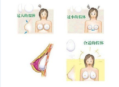 隆胸假体的大小