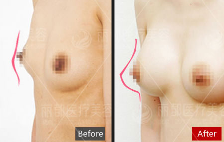 胸部修复案例