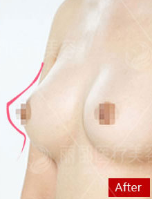 胸部修复案例:乳房萎缩下垂
