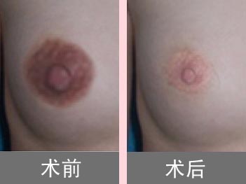 乳晕缩小术的禁忌人群会有哪些