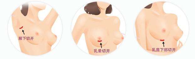  丰胸手术过程，经乳晕切口，经腋窝切口，隆胸手术，假体隆胸手术