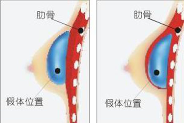 隆胸手术常见的误区