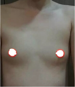 术前照片(假体隆胸后恢复过程图)