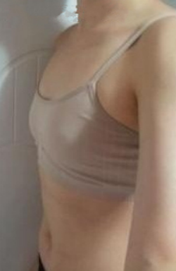 填充360cc硅胶假体隆胸后 穿吊带炒鸡性感！