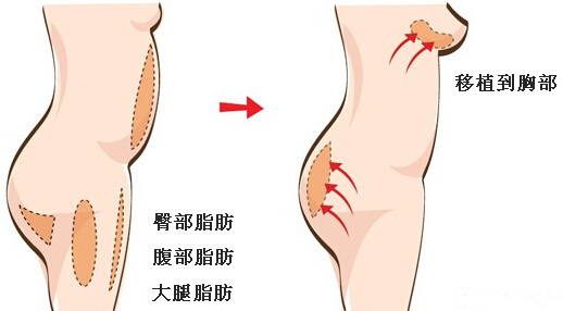 自体脂肪隆胸的优缺点