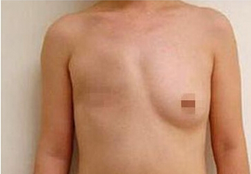 乳房再造术