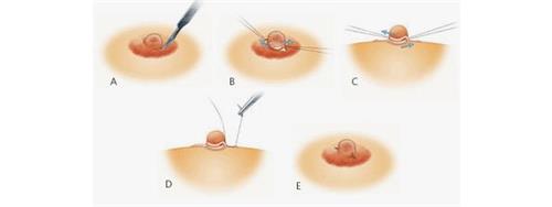 乳头内陷矫正的手术方法